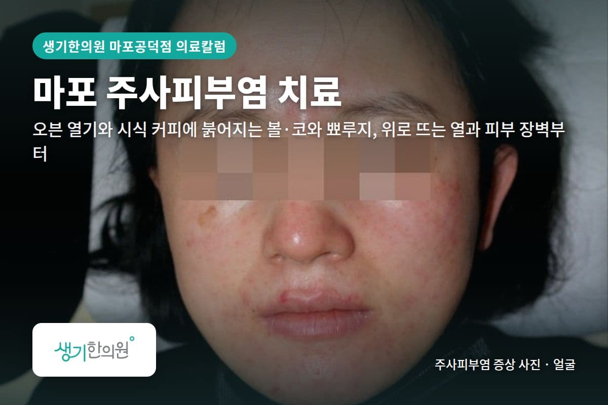 얼굴 주사피부염 증상 사진과 문구 「마포 주사피부염 치료, 오븐 열기와 시식 커피에 붉어지는 볼·코와 뾰루지, 위로 뜨는 열과 피부 장벽부터 · 생기한의원 마포공덕점」
