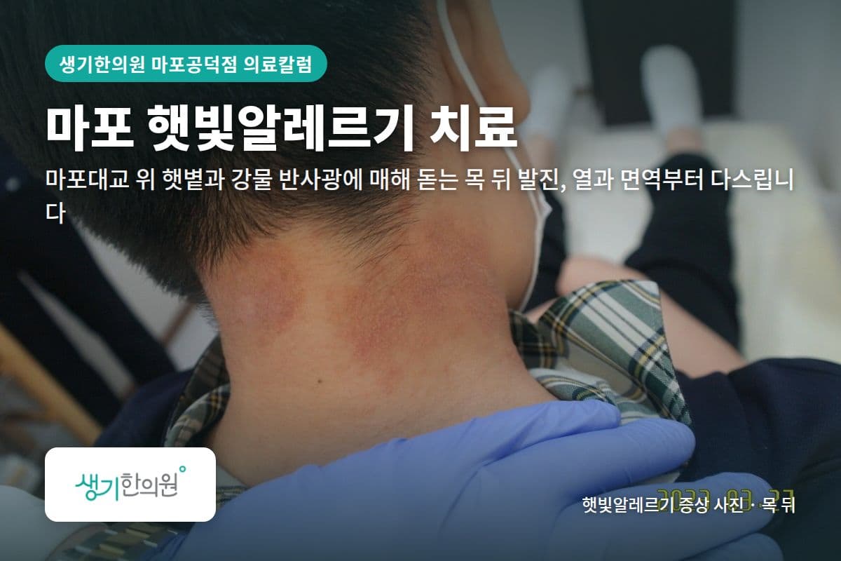 목 뒤 햇빛알레르기 증상 사진과 문구 「마포 햇빛알레르기 치료, 마포대교 위 햇볕과 강물 반사광에 매해 돋는 목 뒤 발진, 열과 면역부터 다스립니다 · 생기한의원 마포공덕점」