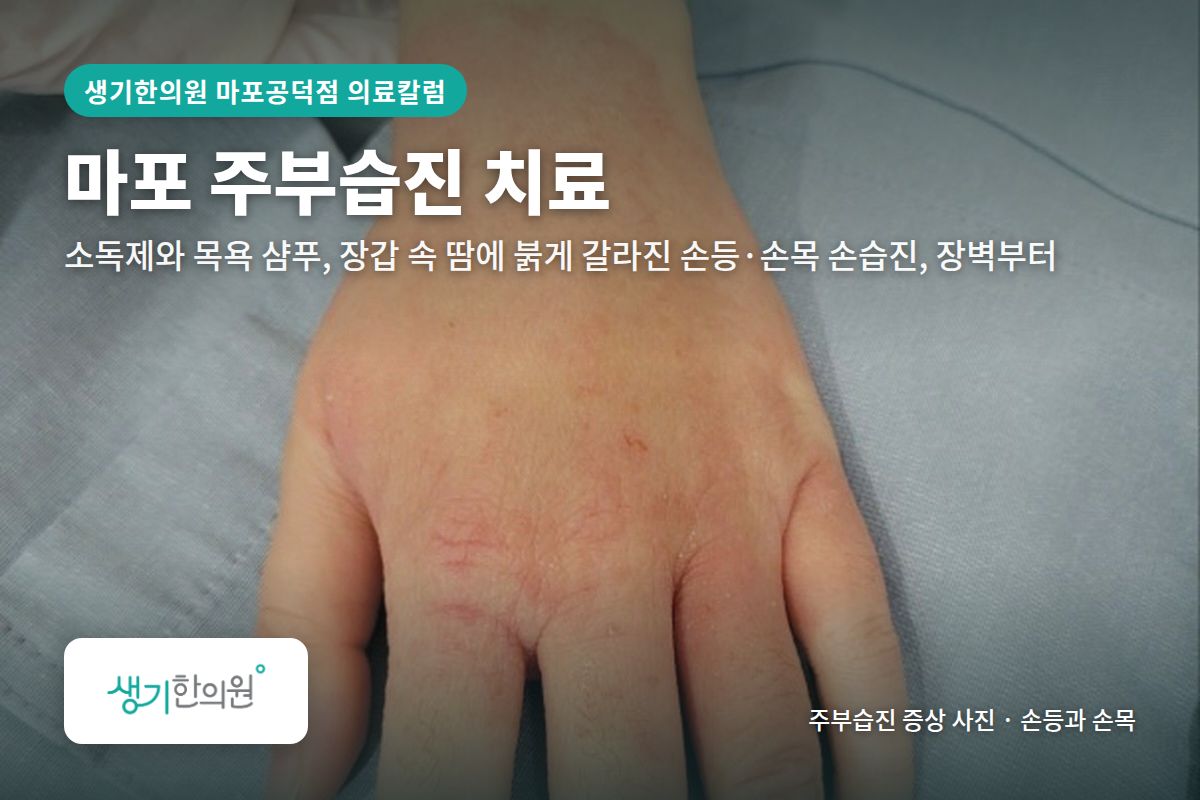손등과 손목 주부습진 증상 사진과 문구 「마포 주부습진 치료, 소독제와 목욕 샴푸, 장갑 속 땀에 붉게 갈라진 손등·손목 손습진, 장벽부터 · 생기한의원 마포공덕점」